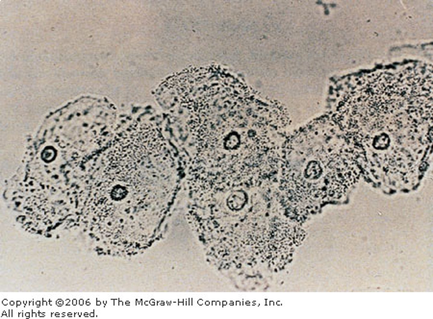 <p>= a drop of normal saline is added to a smear of vaginal secretions <br>+ test: "clue cells" or large squamous epithelial cells that are covered with bacteria</p>