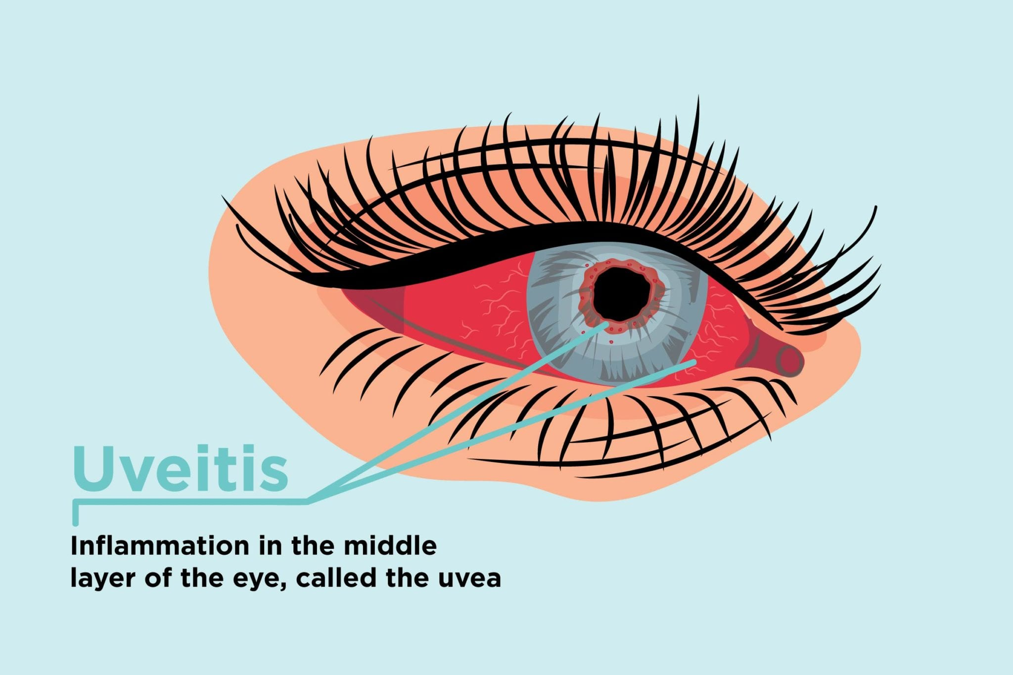 <p>term. uveitis </p>