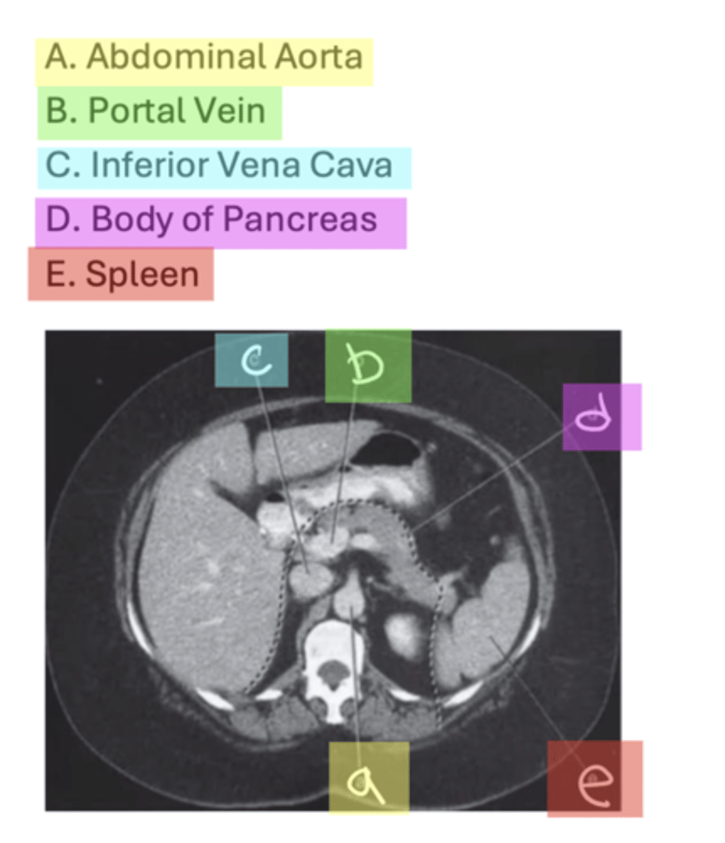 <p>A. Abdominal Aorta B. Portal Vein</p><p>C. Inferior Vena Cava</p><p>D. Body of Pancreas</p><p>E. Spleen</p>