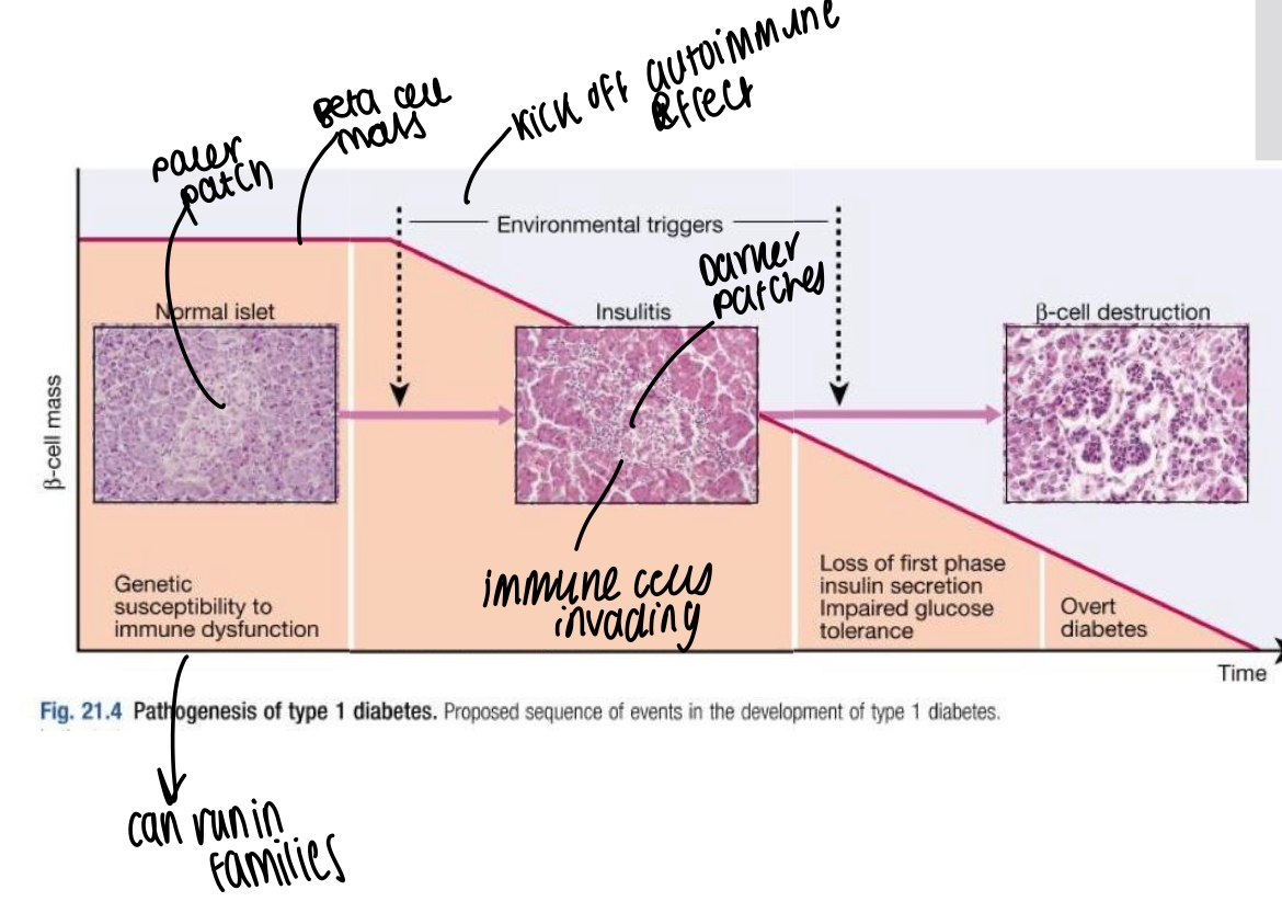 <p>Antibody mediated immune destruction of beta cells from islets of Langerhans, progressive loss occurs over months and years and usually appeared in adolescence where hyperglycaemia noticed when 80-90% of beta cells lost </p>