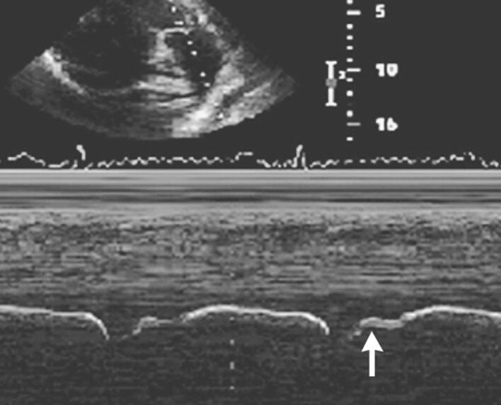 <p>What is seen in the m-mode image?</p>