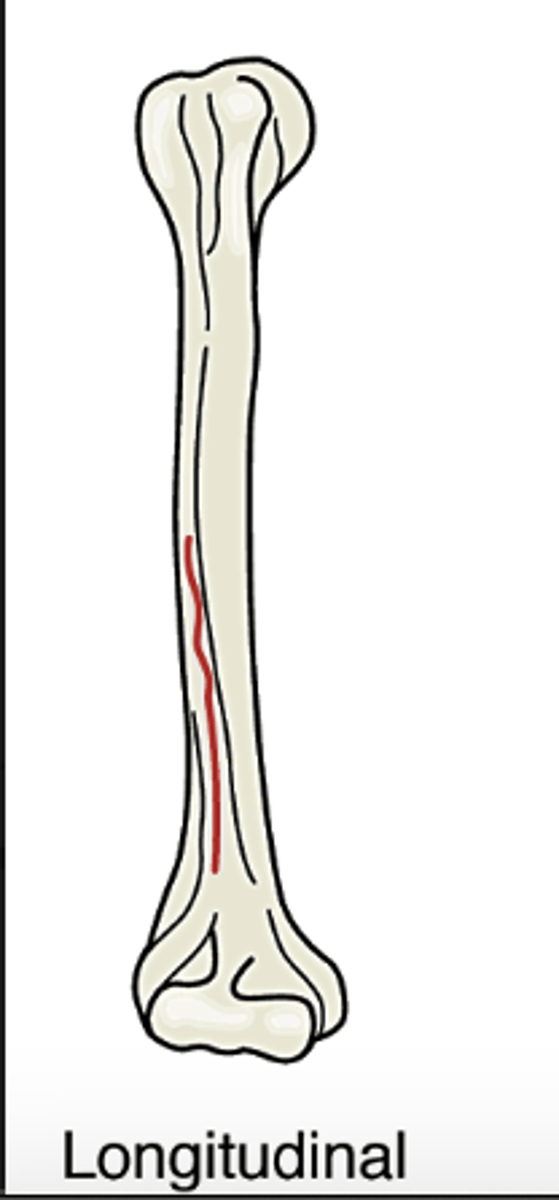 <p>fracture occurs along the length of the bone</p>