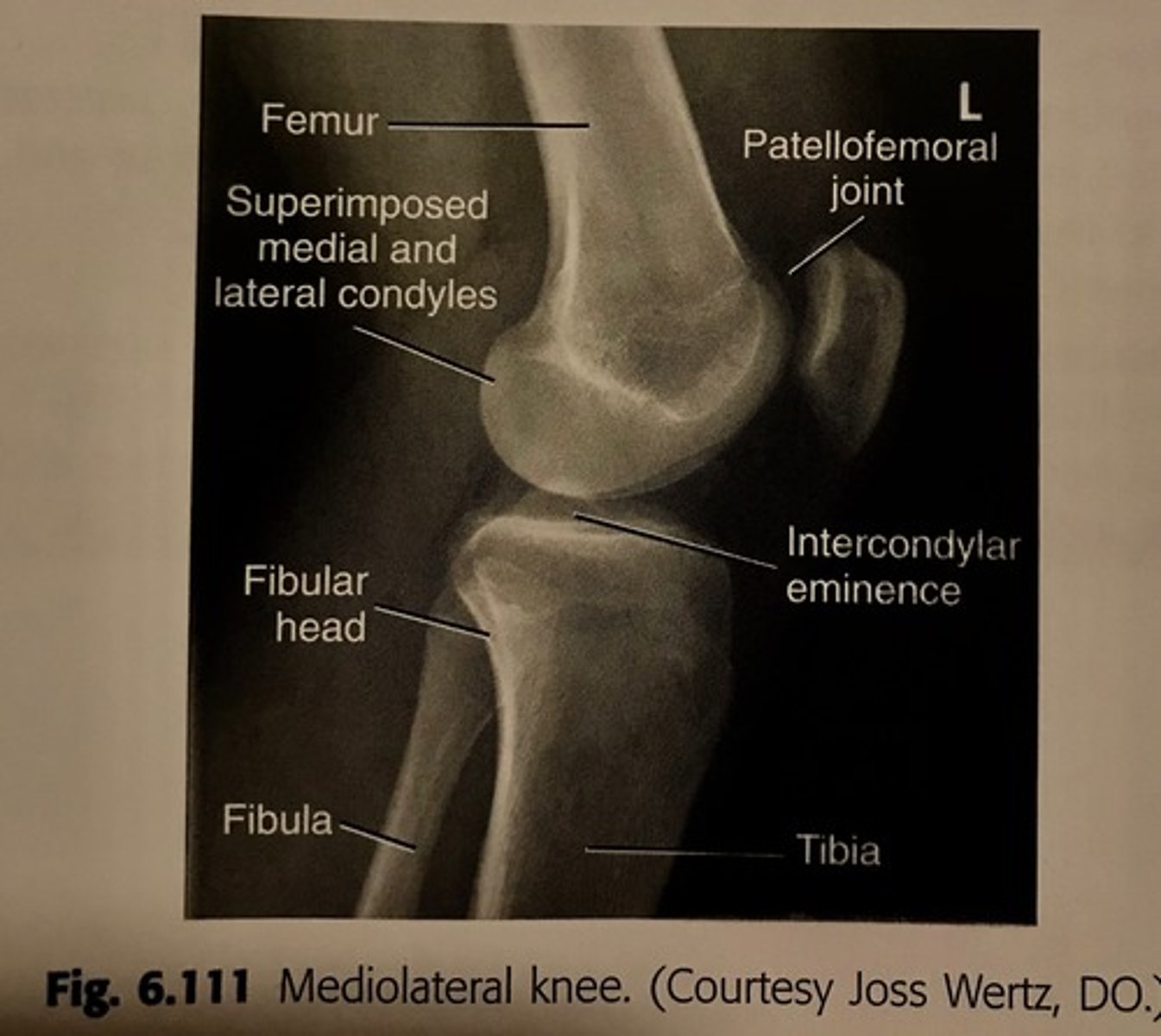 <p>distal femur</p><p>proximal tibia/fibula</p><p>patellofemoral and knee joints should be open</p>