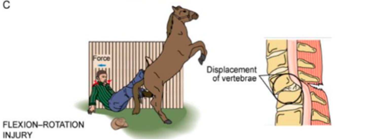 <p>flexion rotation (primary injury)</p>