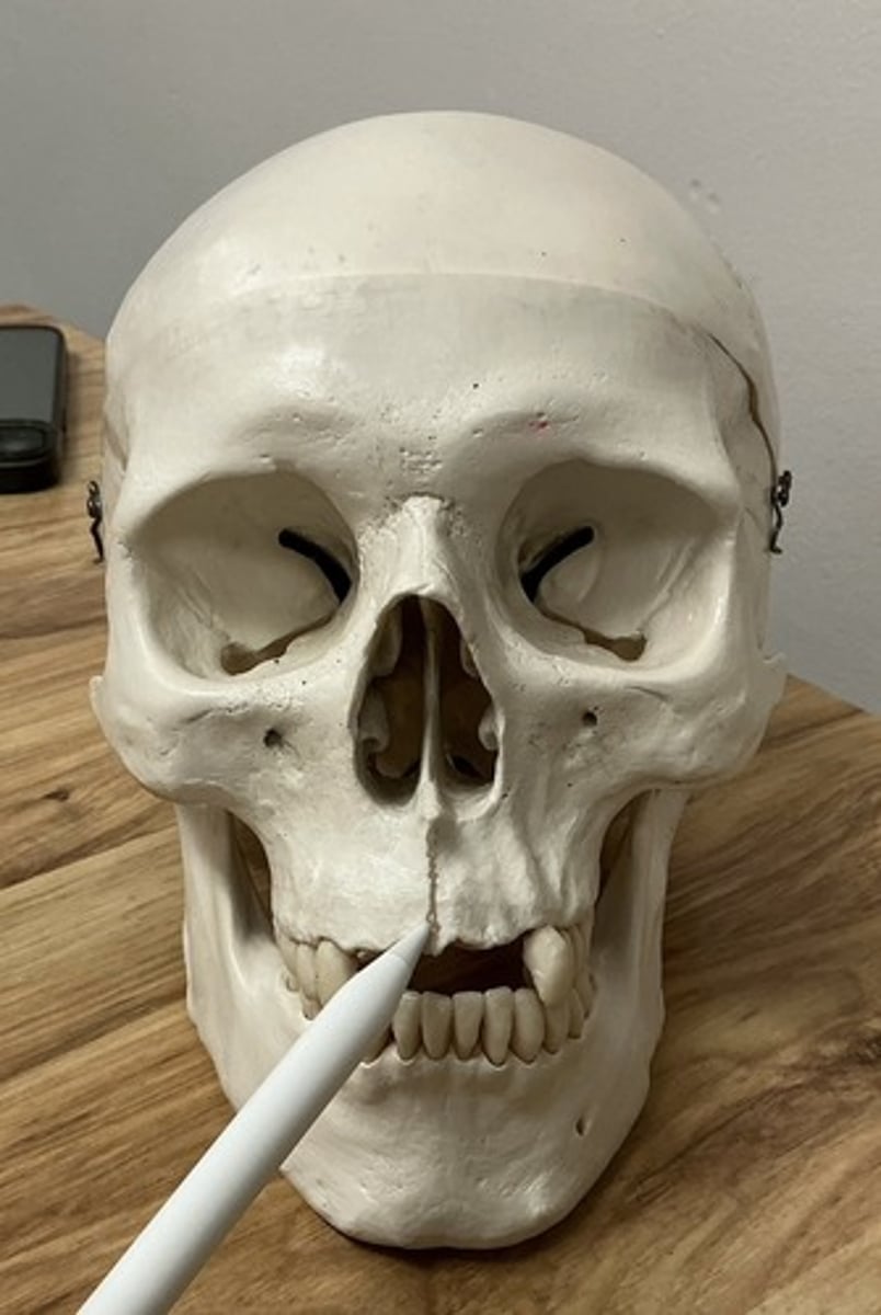 <p>What suture is this?</p>