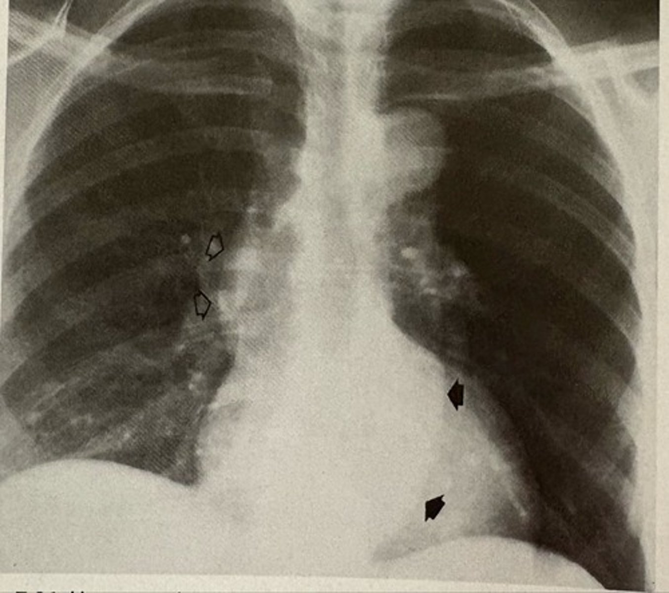 <p>what pathology is present?</p>