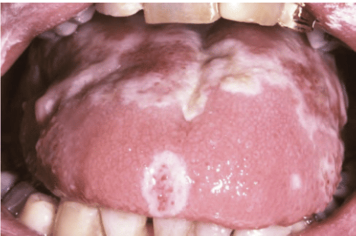<p>Hint: host is immunocompromised; begins on mucosa bound to bone but often spreads to unbound mucosa</p>