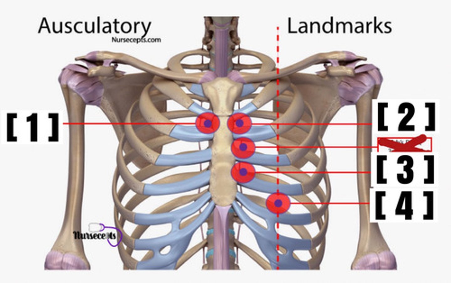 <p>midclavicular line, 5th intercostal space</p>
