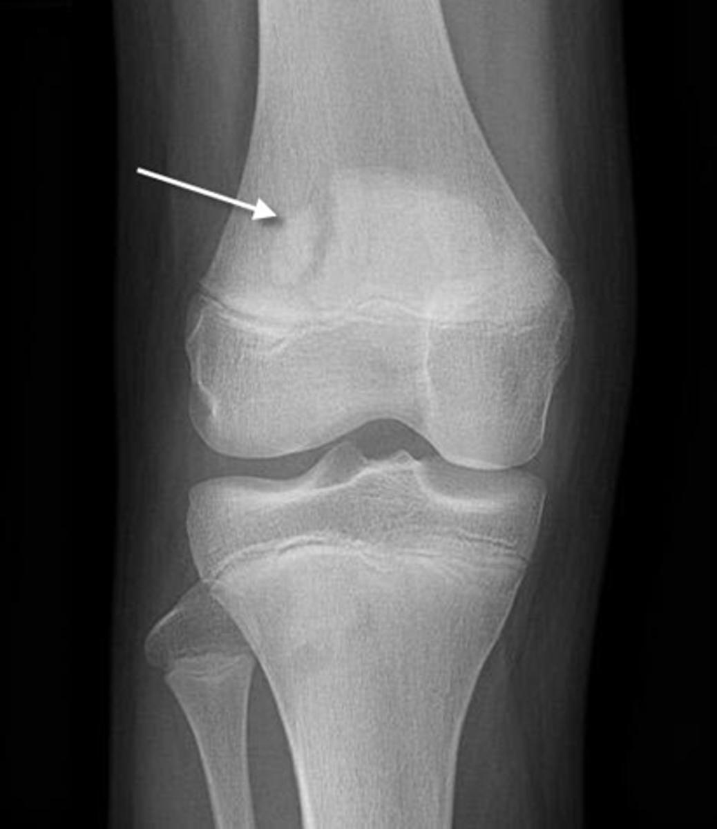 <p><strong>______________</strong> is a normal variant that may appear to be a fracture</p>