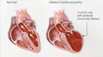 <p>(DCM) Canine Dilated Cardiomyopathy</p>