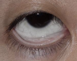 <p>Abnormal Finding for <strong><em>7. Inspect palpebral conjunctiva</em></strong></p><ul><li><p>Heart or lung disorder</p></li></ul><p></p>