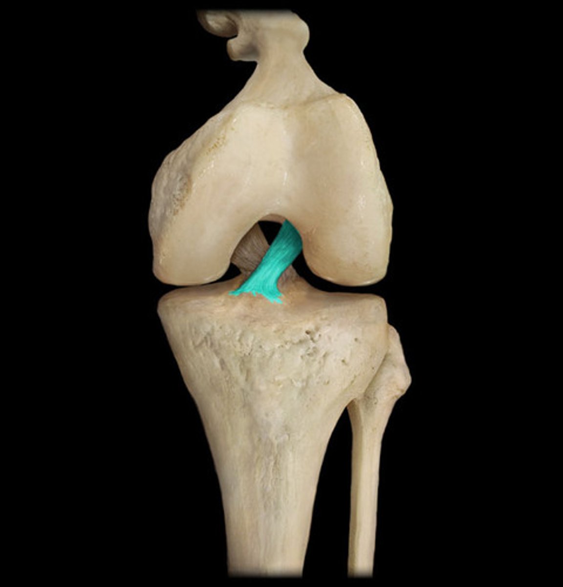 <p>- a ligament in the knee that attaches to the anterior aspect of the tibial plateau.</p><p>- restricts anterior movement of the tibia on the femur</p><p>- Limits posterior excursion (sliding) of femoral condyles on tibial plateaus when knee flexed</p><p>- weaker than PCL</p>