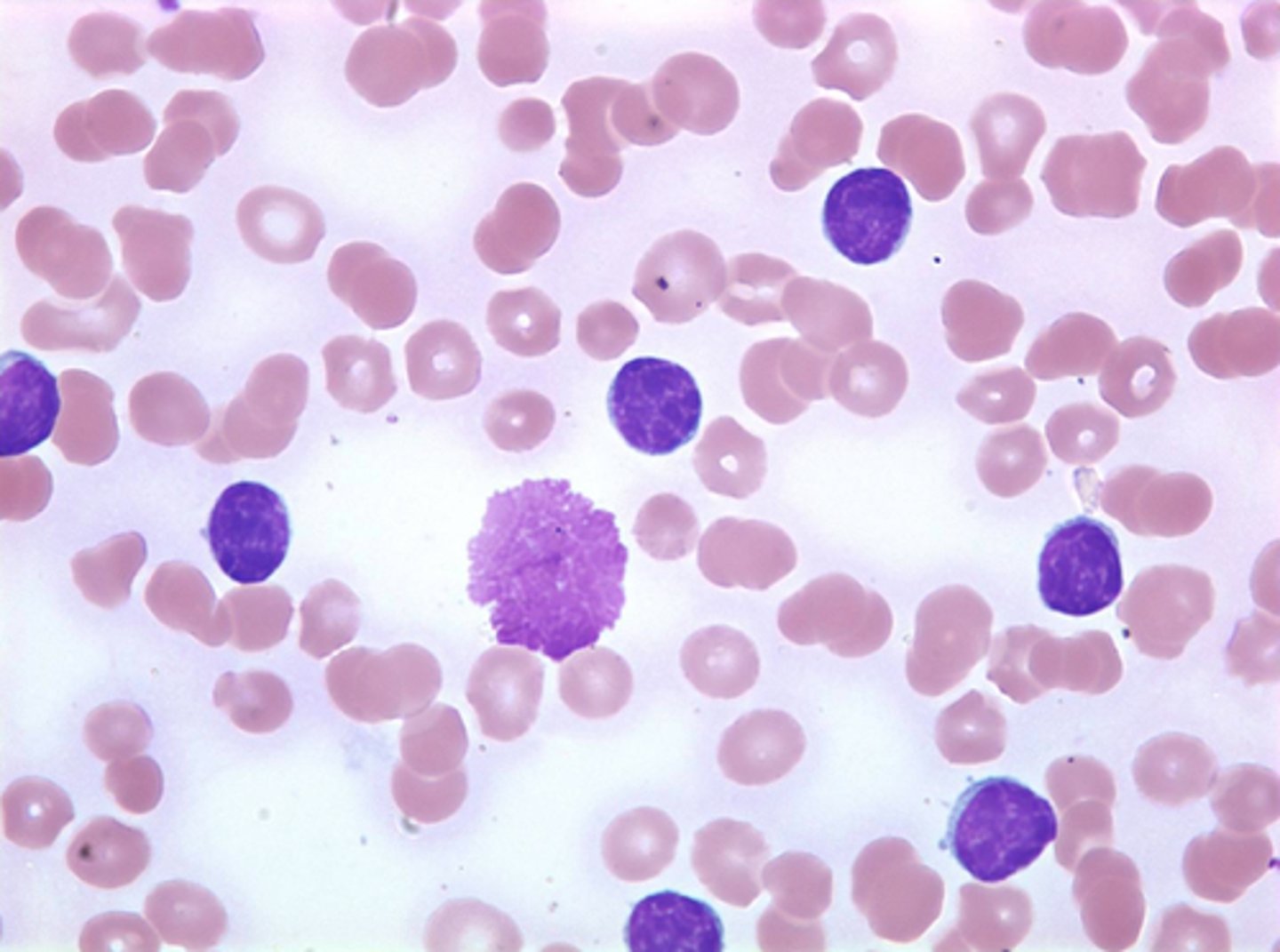 <p>over production of faulty WBC</p><p>chronic; adults</p><p>acute; children</p>