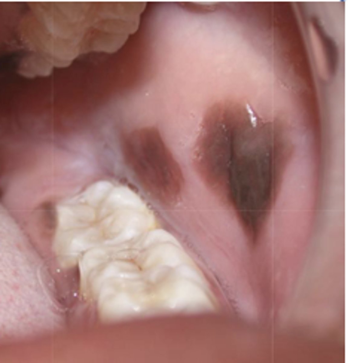 <p>What type of pigmented lesion?</p>