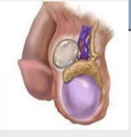 <p><strong>Spermatocele</strong></p><p>-Also called an epididymal ____, usually painless</p><p>-Transilluminates ______ in the scrotum than a hydrocele</p><p>-Palpation → round, freely _________ mass lying above and behind the testis </p><ul><li><p>If large enough, can sometimes feel like a third _________</p></li></ul><p></p>