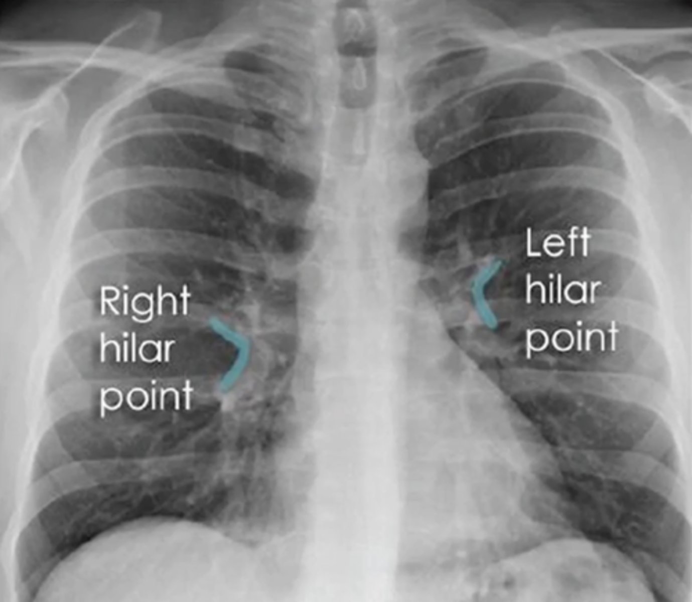 <p>(evaluating AP CXR) normal pulmonary vasculature and hilum</p>