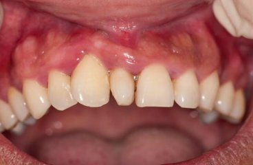 <p>type of hyperdontia </p>