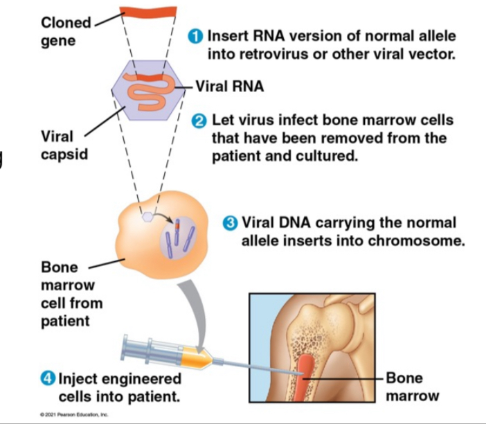 <p>A technique to correct single gene disorders by altering the genetic code of an individual's cells, often by inserting a normal allele into the affected tissue via virus or CRISPR.</p>