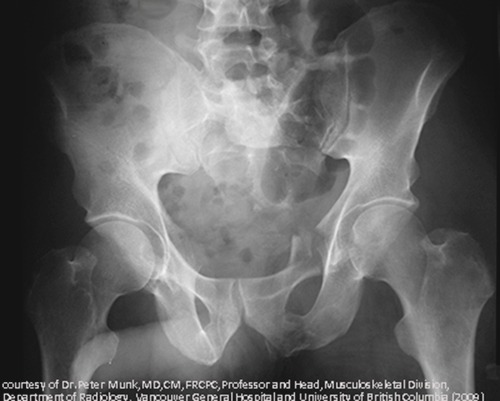 <ul><li><p>highly unstable and result in fractures along the <strong>axis, pubic rami, SI joints and sacrum; associated heavy bleeding</strong></p></li><li><p>MOI = severe axial force, for example, a fall from a height</p></li><li><p>Surgical intervention</p></li><li><p>Ongoing low back pain. Some pelvic obliquity with or without a limp. Poor function related to nerve injuries</p></li></ul><p></p>