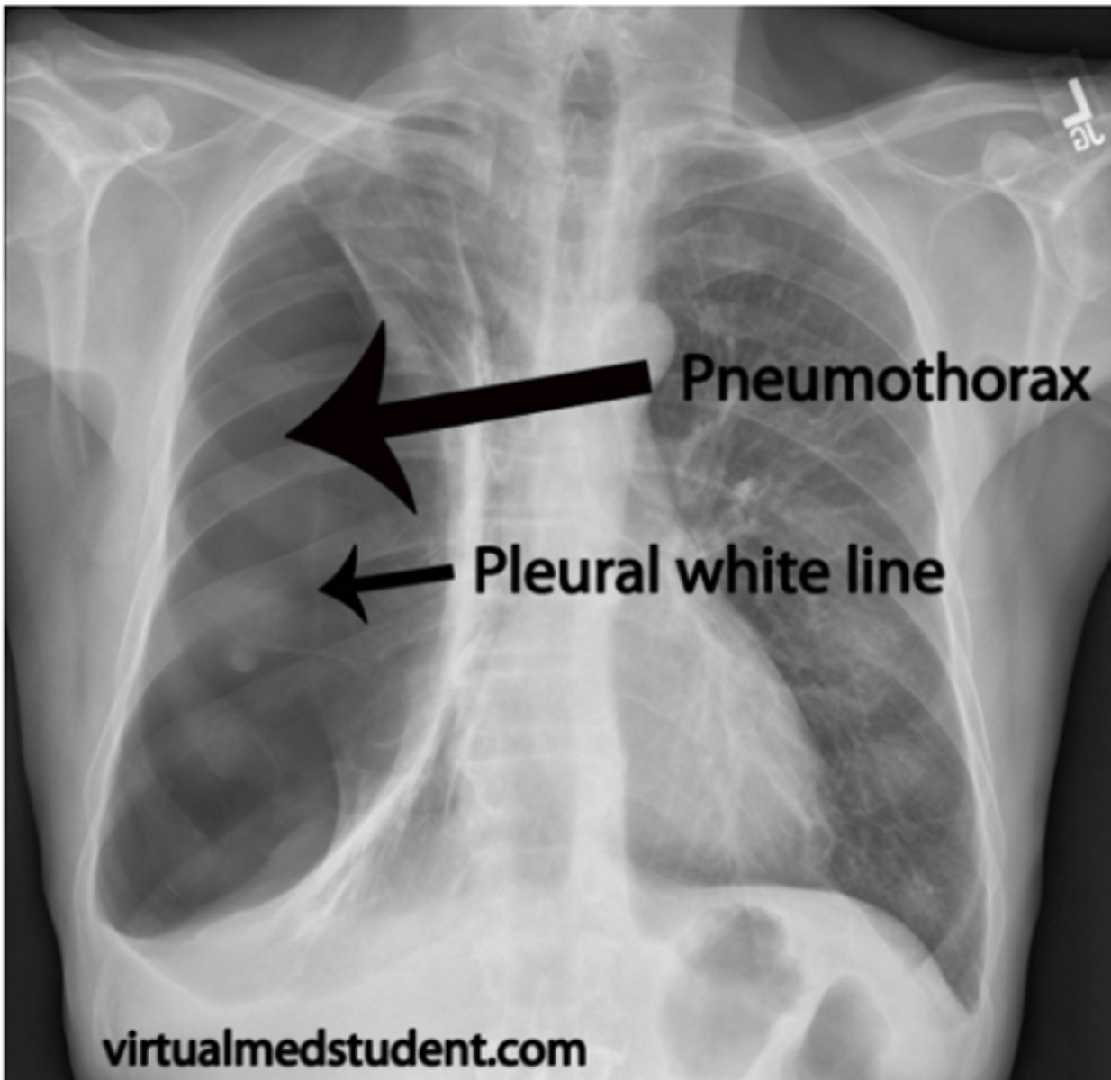 <p>If air enters the pleural cavity (e.g., due to trauma or lung rupture), the negative pressure is lost, creating a real cavity instead of a virtual one.</p><p>This condition leads to:Lung collapse.</p>