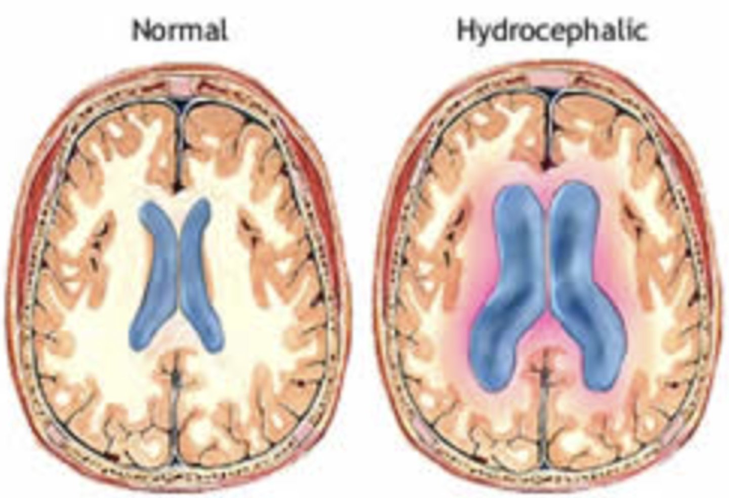 <p>- "water head"</p><p>- Obstruction of CSF flow leads to enlargement of ventricles, compression of brain tissue and expansion of the head</p><p>- Severity associated with poorer neurological outcomes</p>