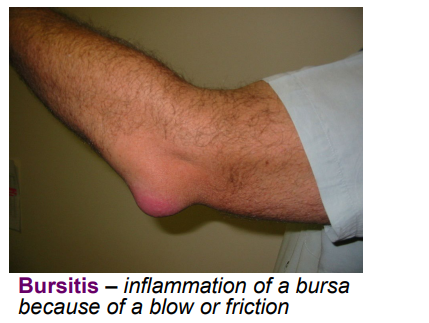 <ul><li><p>overuse</p></li><li><p>cure: antibiotics for infected bursa, anti-inflammatory agents</p></li></ul><p></p>