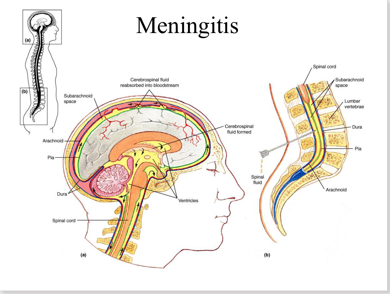<p>inflammation of the menges</p><p>(dura, arachnoid, pia)</p>