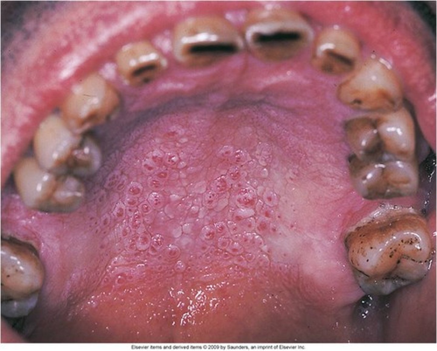 <p>nicotonic stomatitis</p><p>heat from the smoke, not the chemicals</p><p>is reversible, need to stop smoking</p>