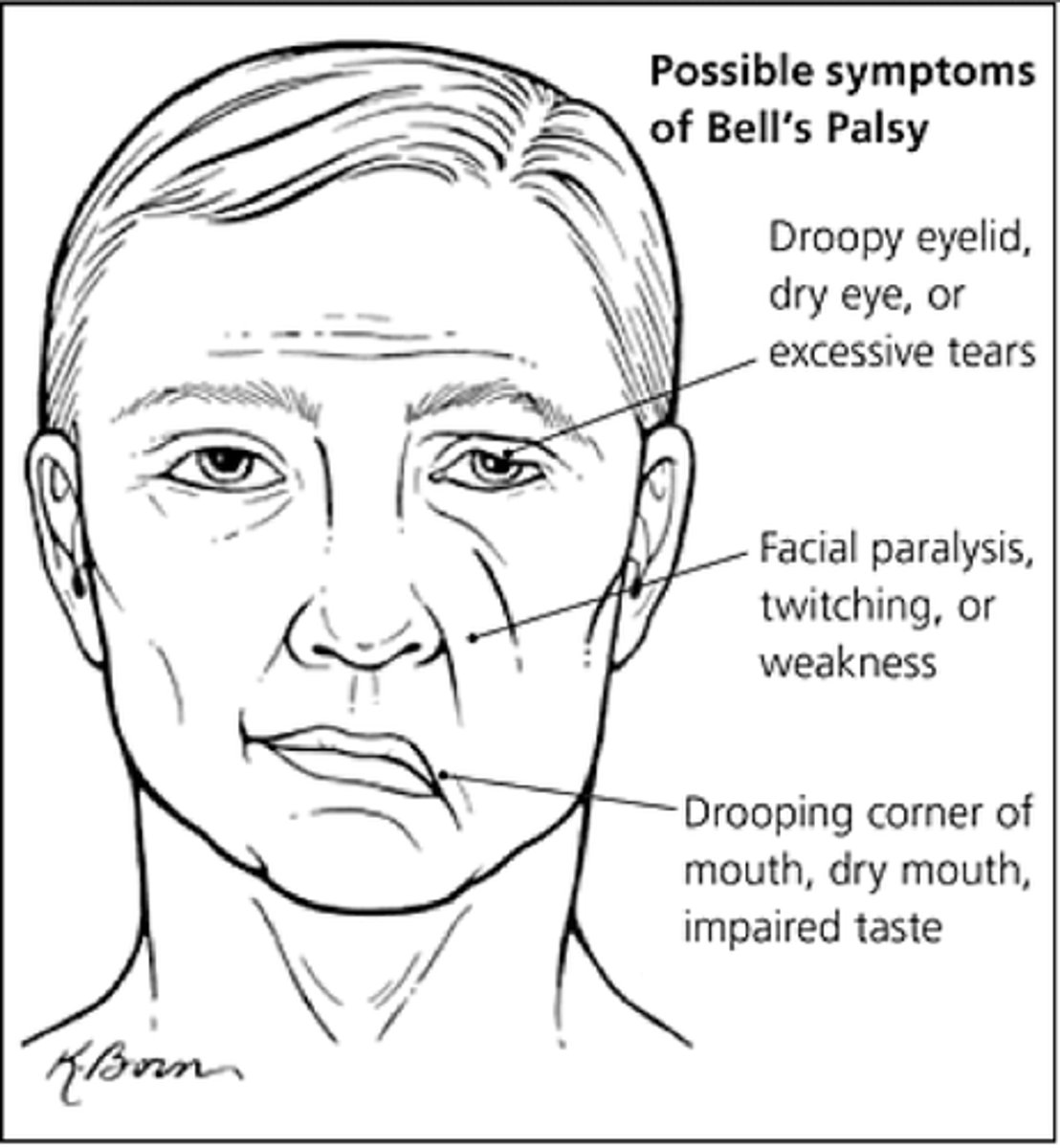 <p>facial nerve palsy</p>