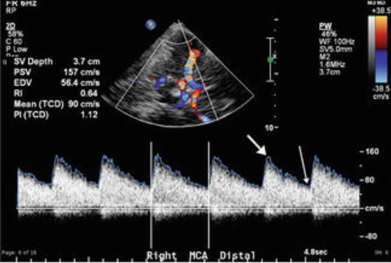<p>Patient s/p CVA and intracranial endovascular procedures to remove thrombus. Patient in neuro ICU and you are called to bedside to evaluate for vasospasm. You take this image. What does it indicate? </p>