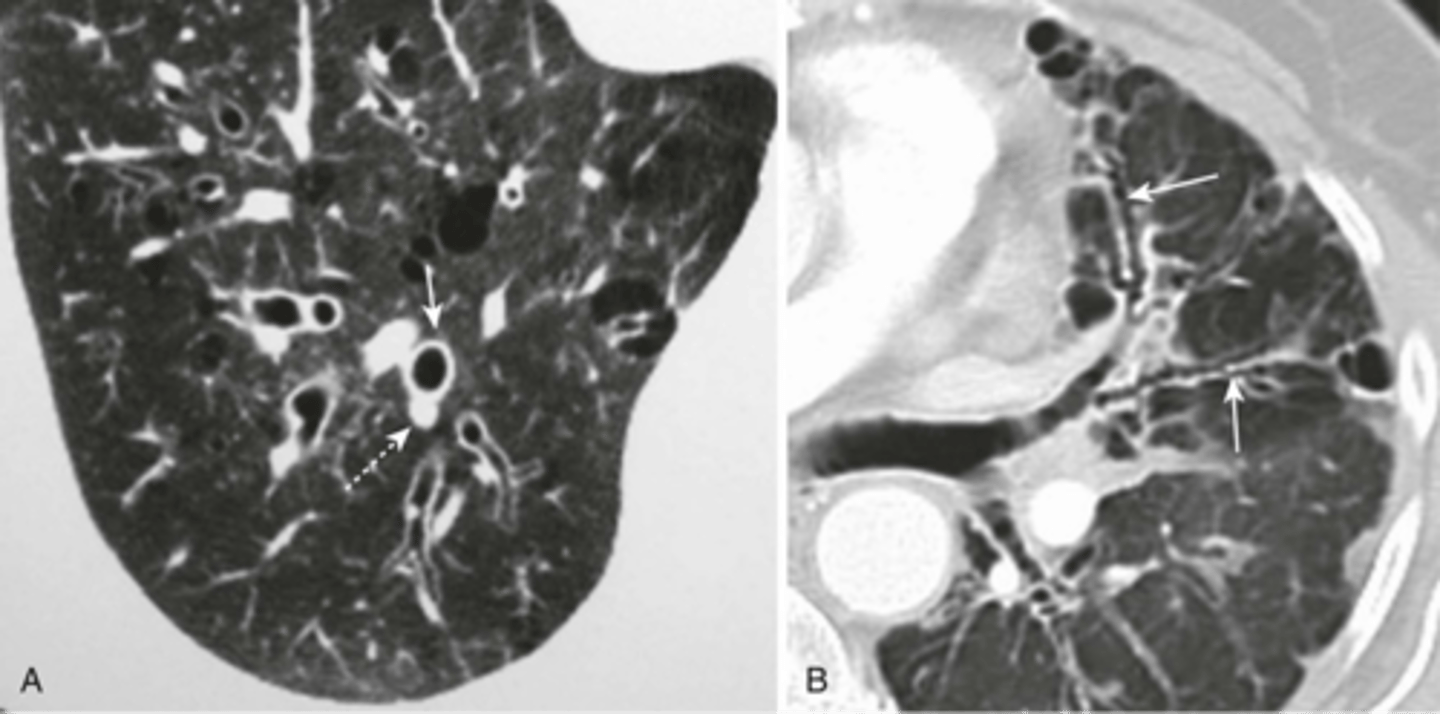 <p>-parallel line opacities (tram tracks)</p><p>-signet ring signs</p><p>-thickened walls of dilated bronchi</p><p>-cystic lesions</p>