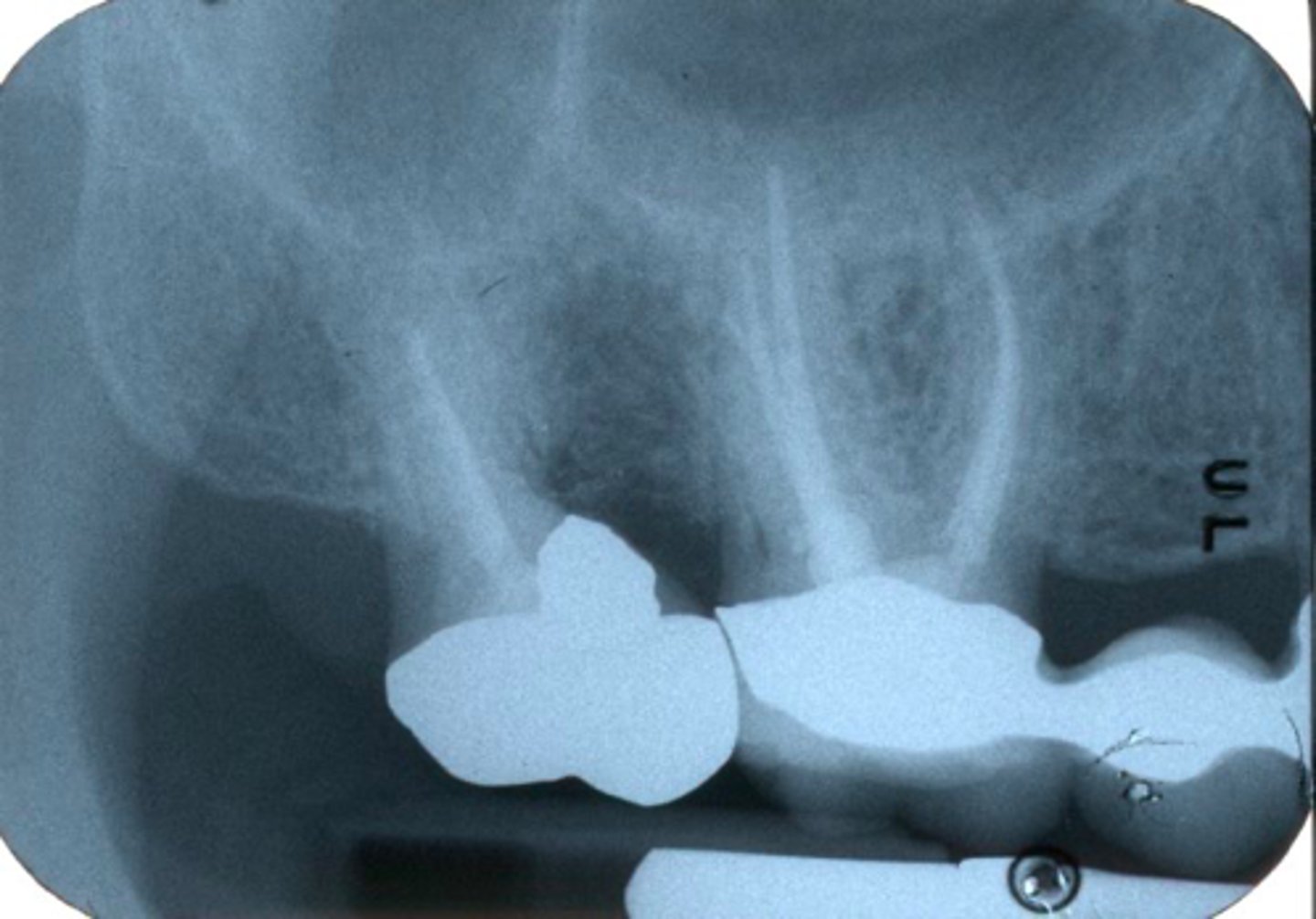 <p>ID the surgical procedure:</p><p>Removal of root that is unsound</p>