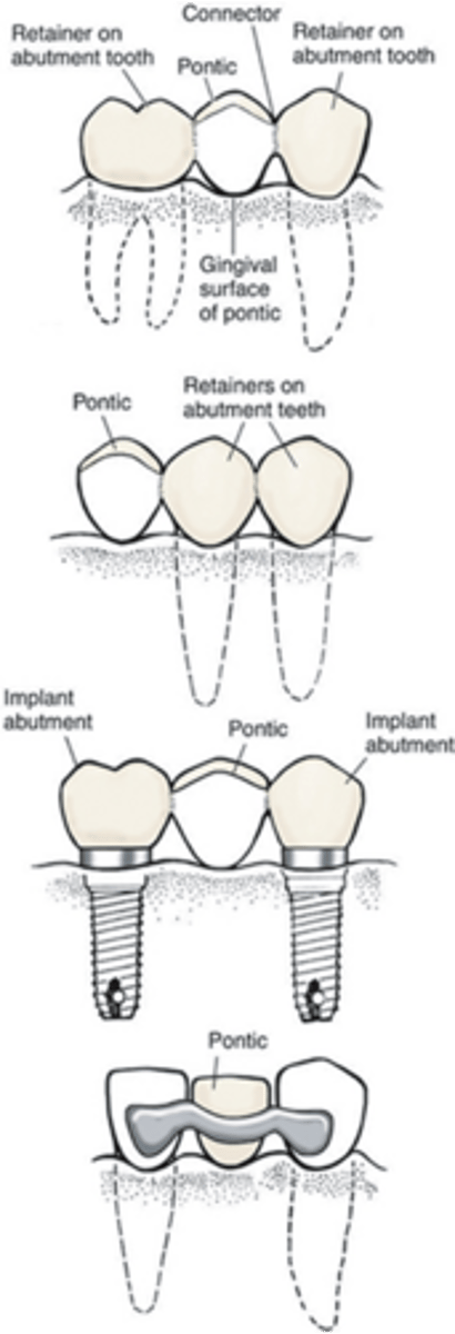 <p>traditional/bilateral</p><p>cantilever</p><p>implant supported</p><p>resin retained (maryland bridge)</p>