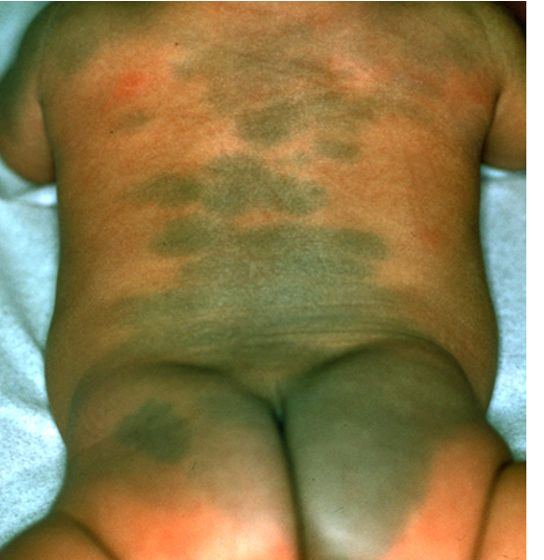 <p><strong>Wha tis a pigmentation in newborns to the sacral gluteal region, MC in asians &amp; disappears by ages 6-10 y/o?</strong></p>