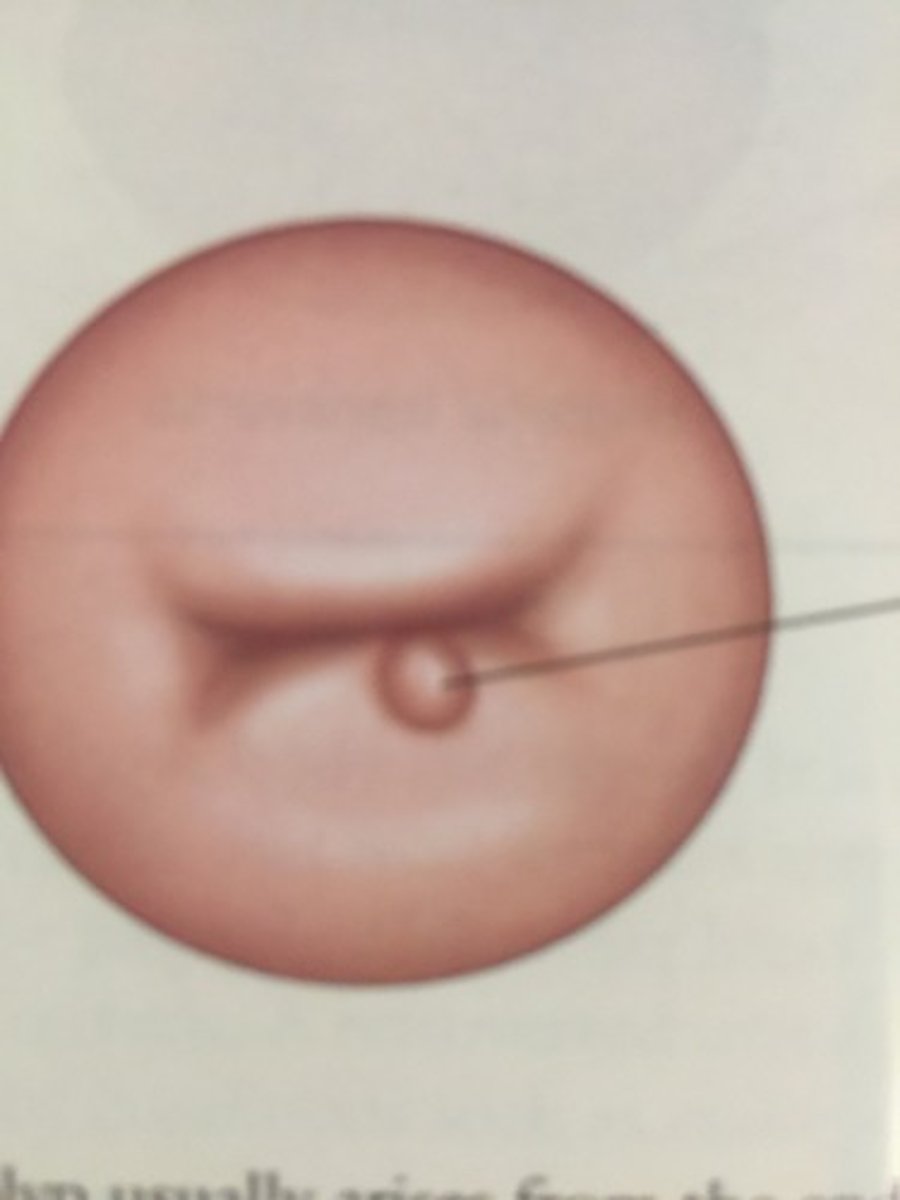 <p>arises from the endocervical canal, bright red, soft, fragile; benign but may bleed</p>