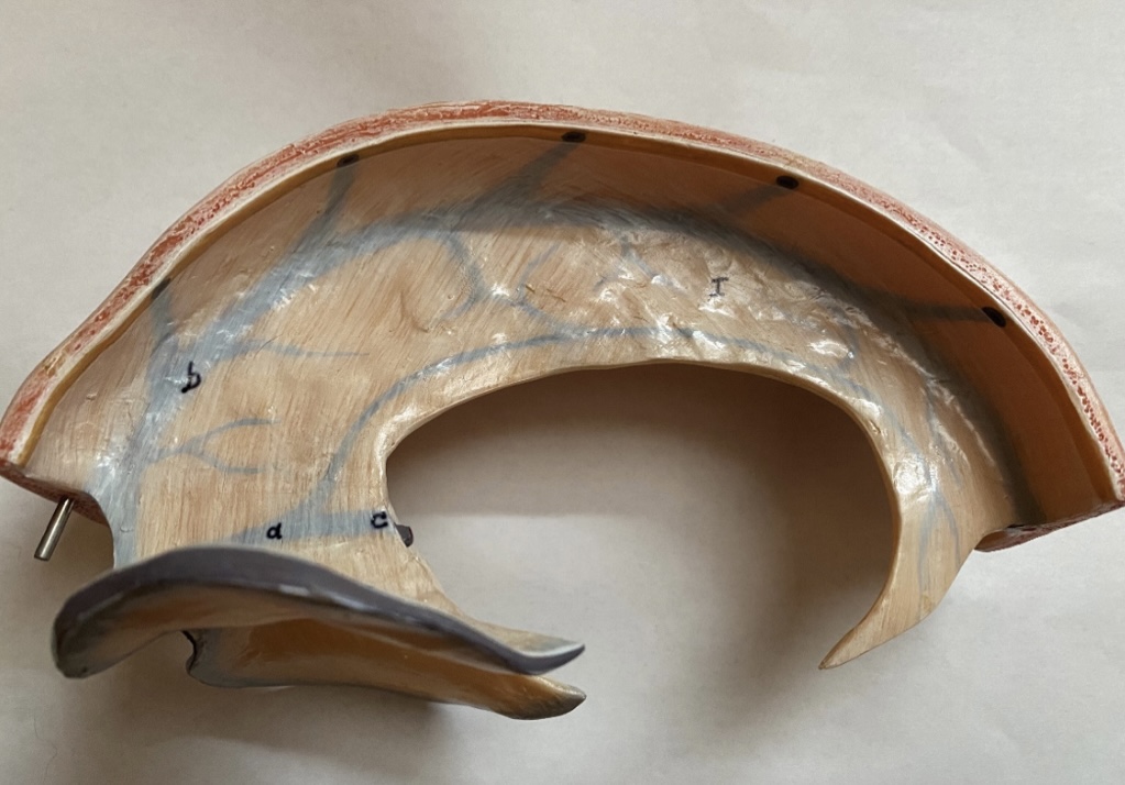 <p>dura mater folds: falx cerebri</p>
