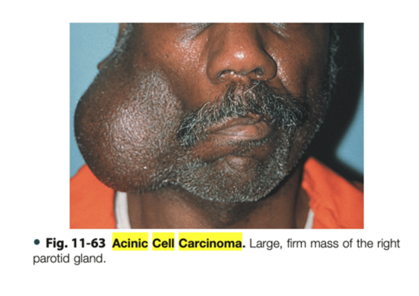 <p>Malignant Salivary Gland Tumors: </p><p>-Low grade malignant tumor</p><p>▫ serous acinar cells</p><p>-Wide age range 2nd-7th decade of life</p><p>-Most common site: parotid gland (85%)</p><p>▫ 9% minor salivary glands</p><p>-Female predilection</p>