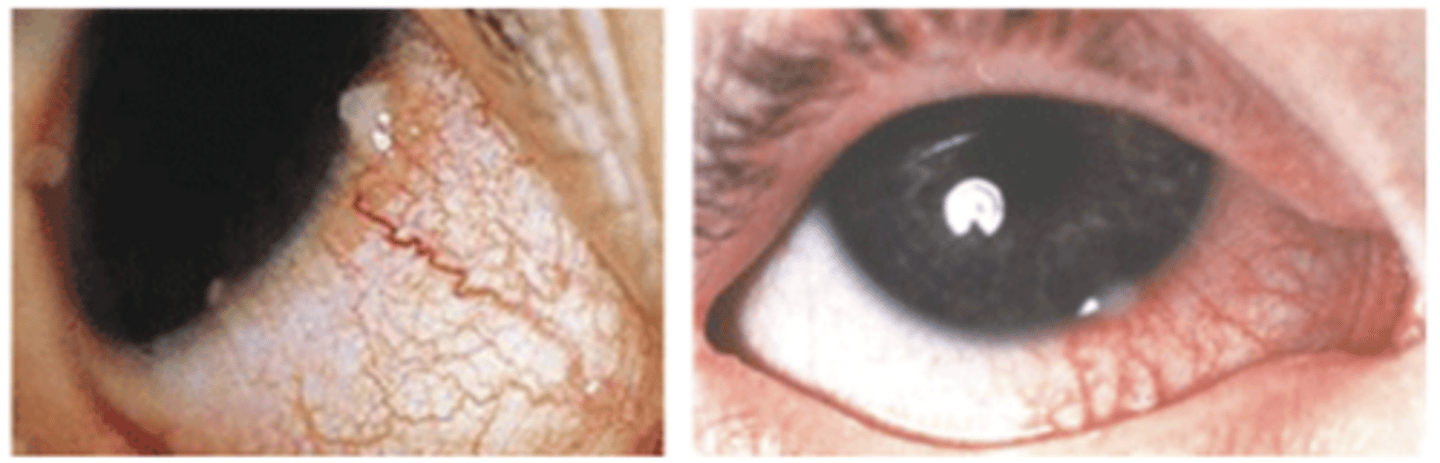 <p>What is an example of a marginal keratitis?</p>