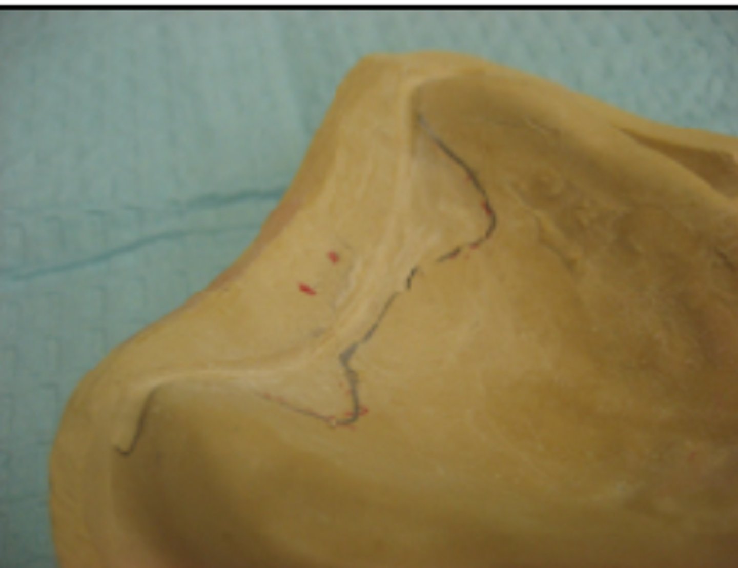 <p>What instruments can you use to square the channel created here and relieve it?</p>