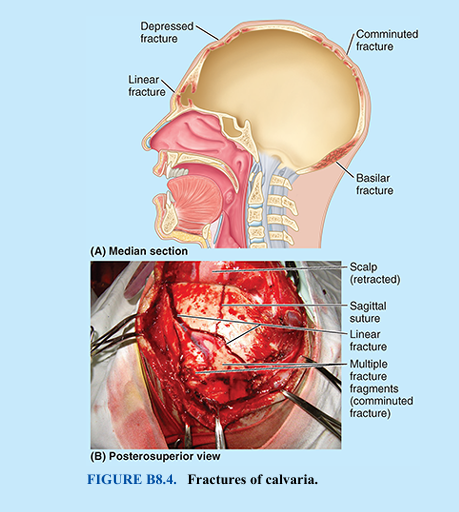 <p>The convexity of the calvaria distributes and thereby usually minimizes the effects of a blow to the head. However, hard blows in thin areas of the calvaria are likely to produce depressed fractures, in which a bone fragment is depressed inward, compressing and/or injuring the brain (Fig. B8.4). Linear calvarial fractures, the most frequent type, usually occur at the point of impact, but fracture lines often radiate away from it in two or more directions. In comminuted fractures, the bone is broken into several pieces. If the area of the calvaria is thick at the site of impact, the bone may bend inward without fracturing. However, a fracture may occur some distance from the site of direct trauma where the calvaria is thinner. In a contrecoup (counterblow) fracture, no fracture occurs at the point of impact, but one occurs on the opposite side of the cranium.</p>