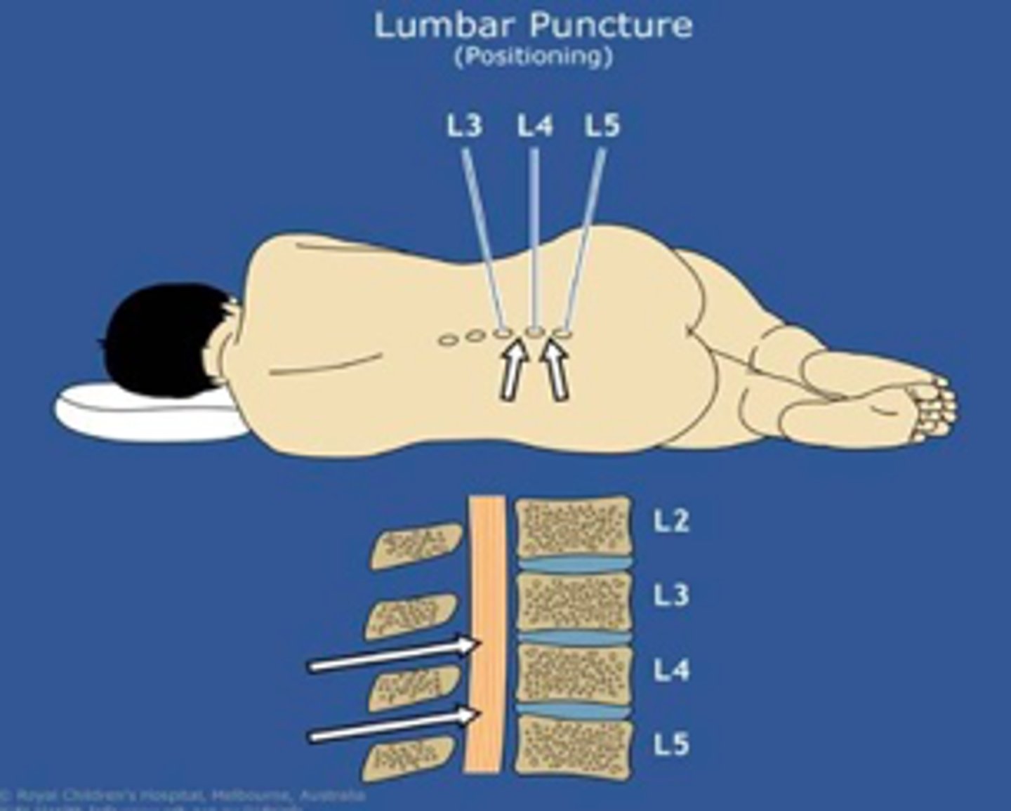 <p>- Raised intracranial pressure</p><p>- Thrombocytopenia/bleeding risk</p><p>- Suspected spinal epidural abscess</p>
