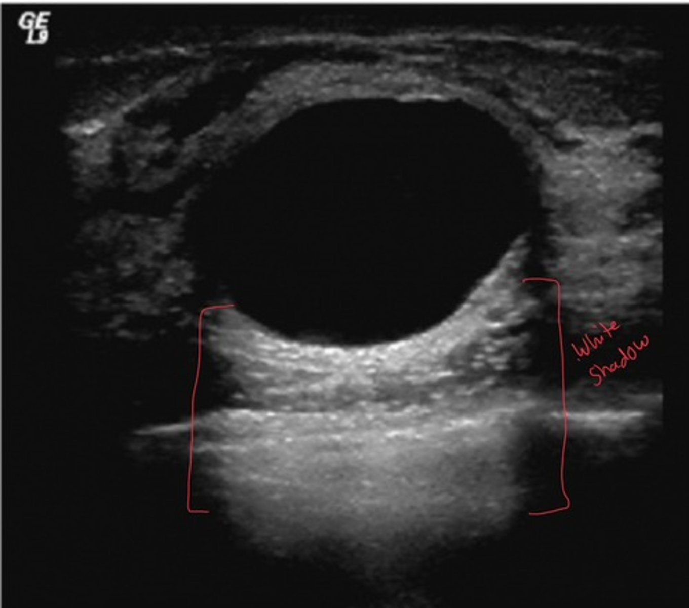 <p>Producing echoes of higher amplitude than the surrounding medium</p><p>specific type of echogenicity meaning the structure appears brighter (whiter) then surrounding tissues because it reflects more sound</p>