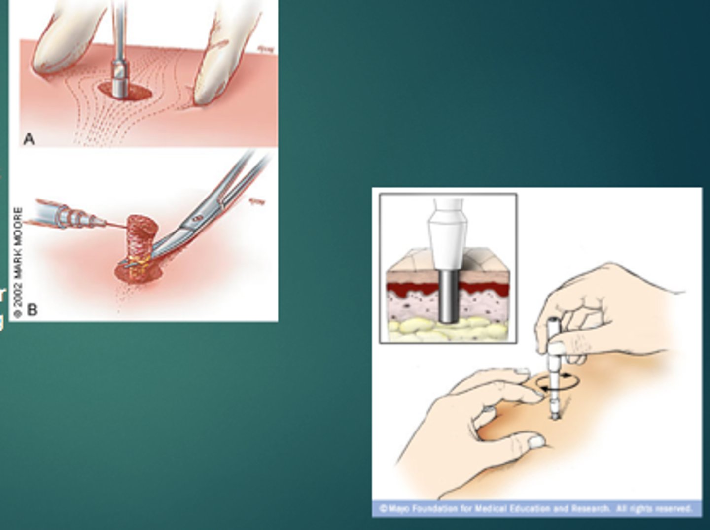 <p>Punch Biopsy</p>
