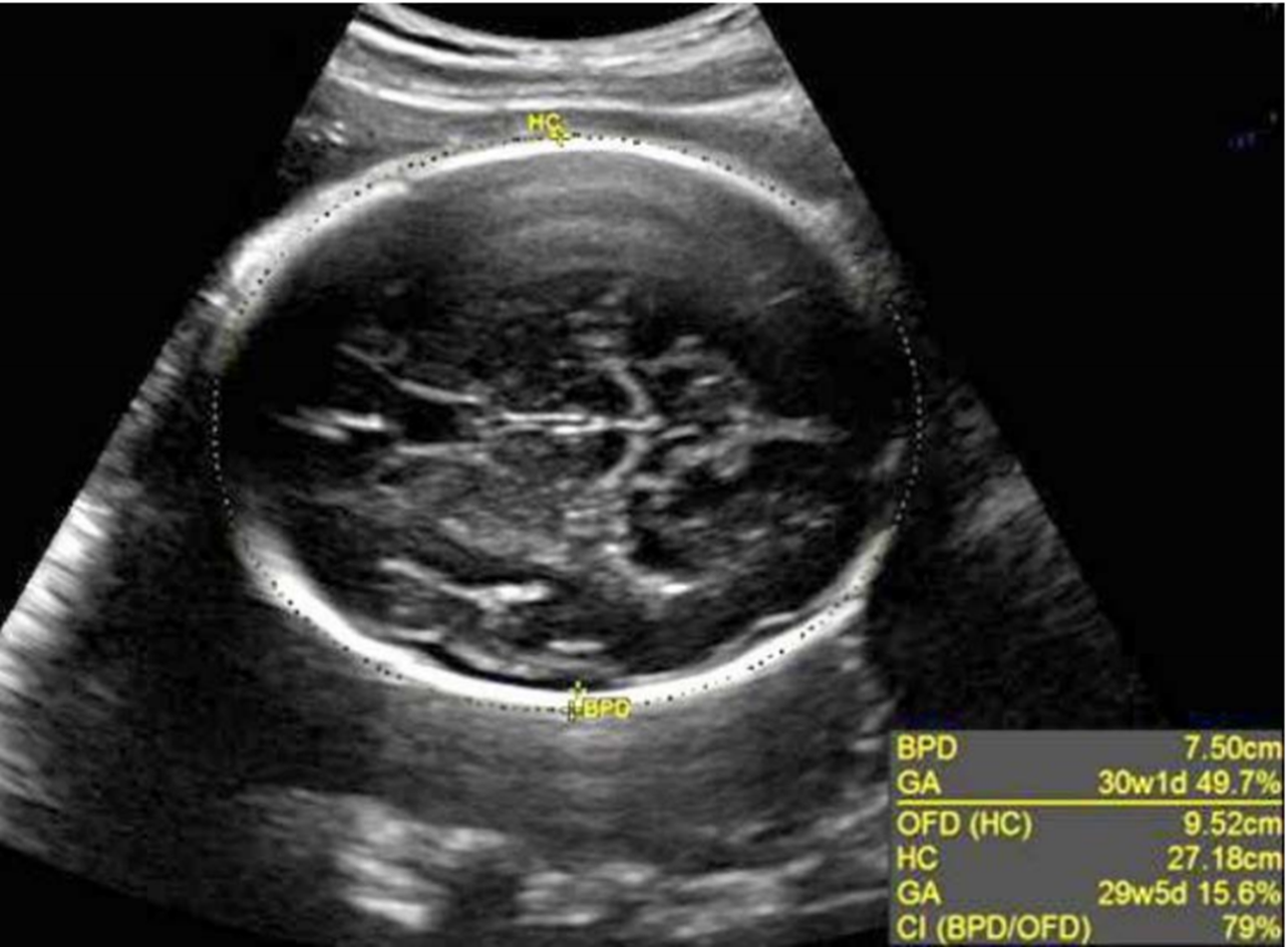 <p>measurement at level of BPD that measures outer perimeter of skull</p>