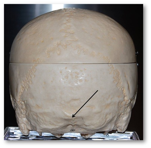<p>bump on back of head</p>