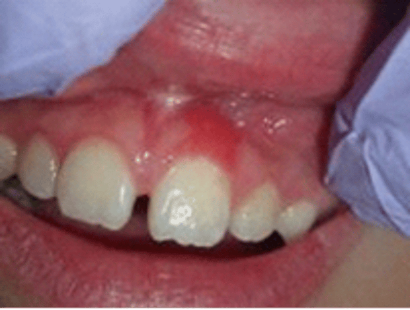 <p>Distinct subtype of gingivitis that does not respond to local plaque control. Appears as papillary or velvety, red nodule that bleeds easily</p>