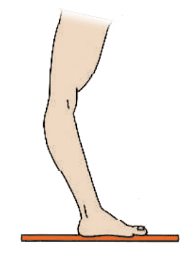 <p><strong>Recurvatum</strong> = <strong>backward bending</strong> of a joint.<br>Example: <strong>Genu recurvatum</strong> = <strong>knee hyperextension</strong>.</p><p>Memory hook: <strong>Re-curve = curve backward</strong></p>