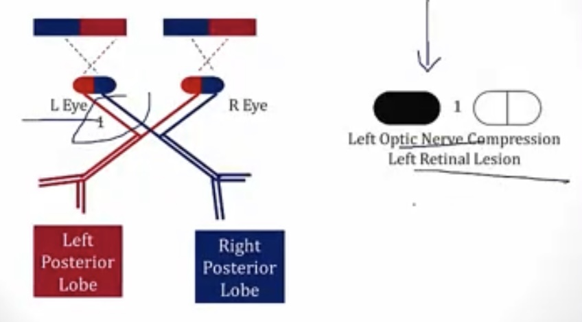 <p>-loss of vision</p><p>-nerve compression; lesion</p>