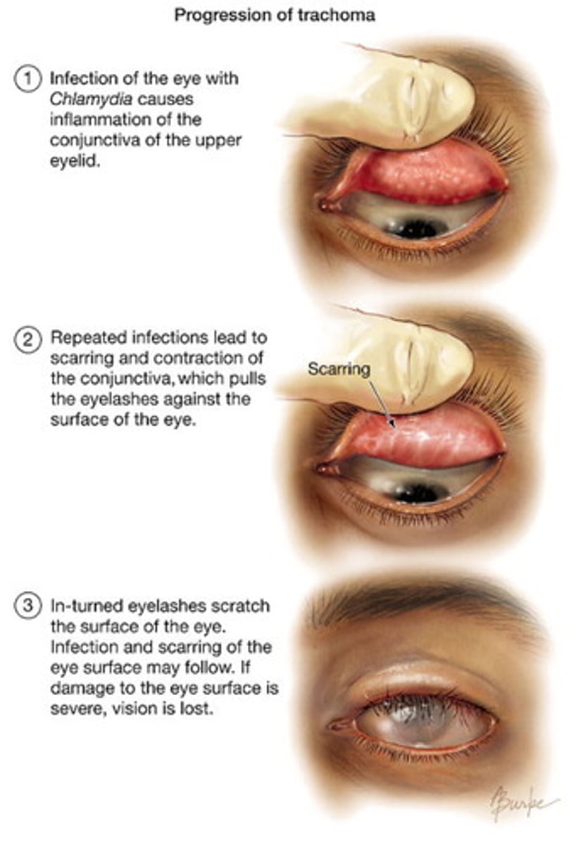 <p>Chlamydia trachomatis</p><p>Inflammation of the <strong>conjunctiva and cornea</strong> --&gt; eyelid swelling, pain, photophobia, blindness</p><p>Transmission: Direct contact with infected ocular secretions, fomites, flies that have touched infected ocular secretions</p>