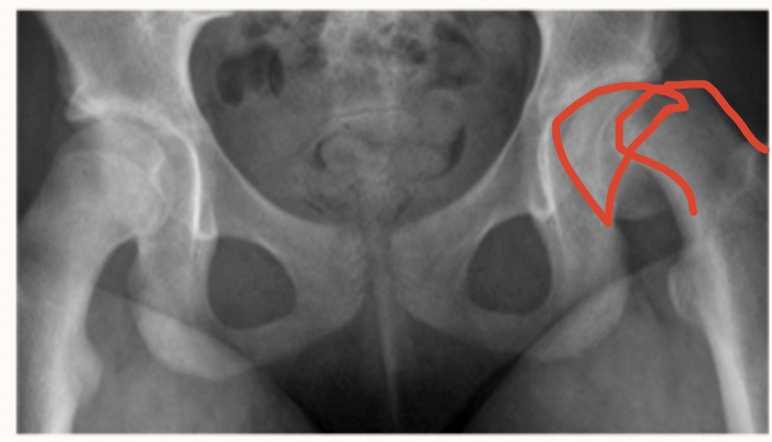 <p>14 y/o obese male presents to the clinic for hip pain that has been going on for the last few months. He states that the pain radiates to the knee. On physical exam you note that the patient prefers to sit with the left hip in external rotation, as well as abnormal leg length, limping gait, and an externally rotated foot. What is your treatment plan?</p>